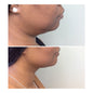 Kybella Injections (fat removal for chin)