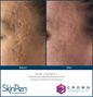 SkinPen Microneedling