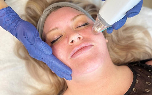 Potenza RF Microneedling